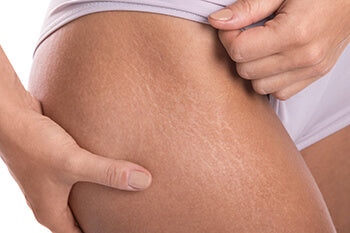 Anti Stretch Mark Cream ( Original )